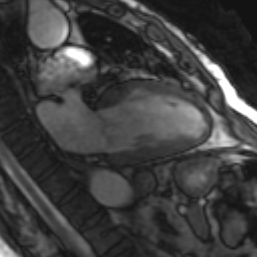 File:Anteroseptal hypokinesia after myocardial infarction (Radiopaedia 15978-15633 2 chamber view SSFE 3).jpg