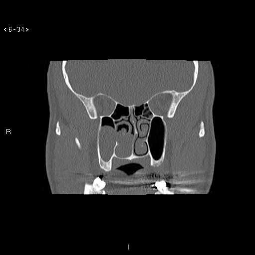 File:Antrochoanal Polyp (Radiopaedia 70510-80631 Coronal bone window 23).jpg
