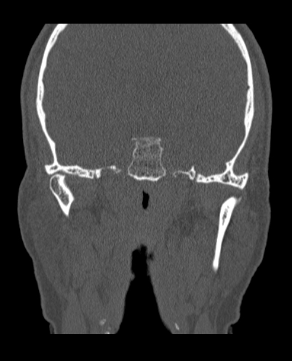Antrochoanal polyp (Radiopaedia 79011-92169 Coronal bone window 1).jpg