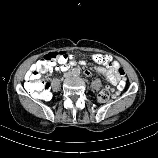 Aortic aneurysm and Lemmel syndrome (Radiopaedia 86499-102554 Axial C+ delayed 49).jpg