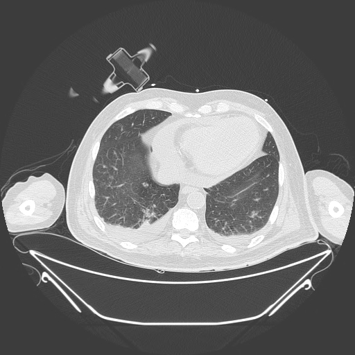 Aortic arch aneurysm (Radiopaedia 84109-99365 Axial lung window 210).jpg