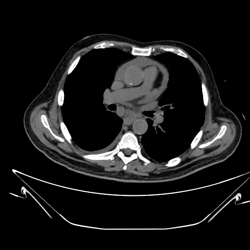 Aortic arch aneurysm (Radiopaedia 84109-99365 Axial non-contrast 135).jpg