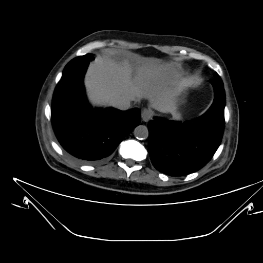 Aortic arch aneurysm (Radiopaedia 84109-99365 Axial non-contrast 233).jpg
