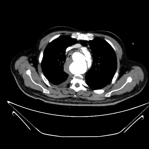 Aortic arch aneurysm (Radiopaedia 84109-99365 C 88).jpg