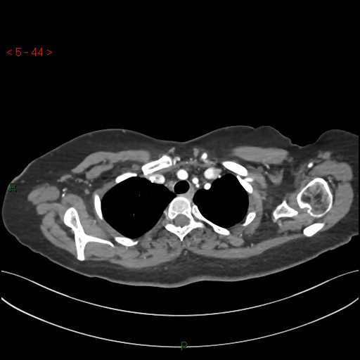 Aortic arch origin of left vertebral artery (Radiopaedia 51520-57286 A 43).jpg