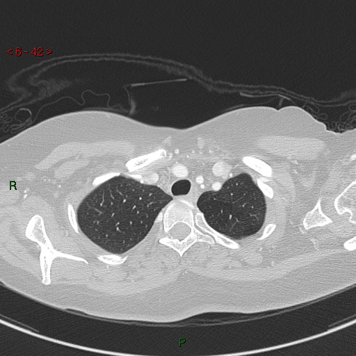 Aortic arch origin of left vertebral artery (Radiopaedia 51520-57286 Axial lung window 42).jpg