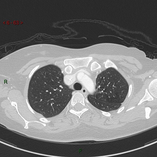 Aortic arch origin of left vertebral artery (Radiopaedia 51520-57286 Axial lung window 63).jpg