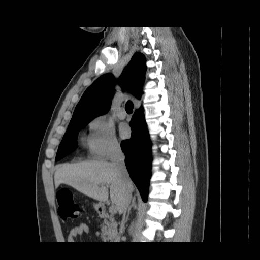 File:Aortic arch stent (Radiopaedia 30030-30595 B 2).jpg