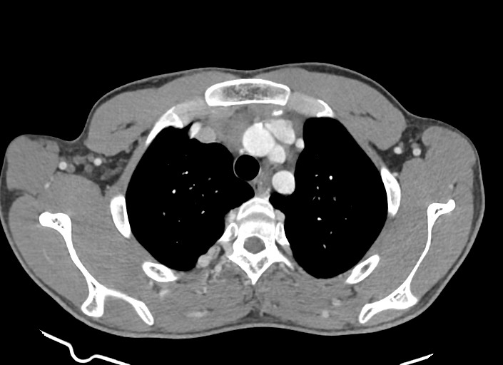 File:Aortic coarctation with aneurysm (Radiopaedia 74818-85828 A 159).jpg