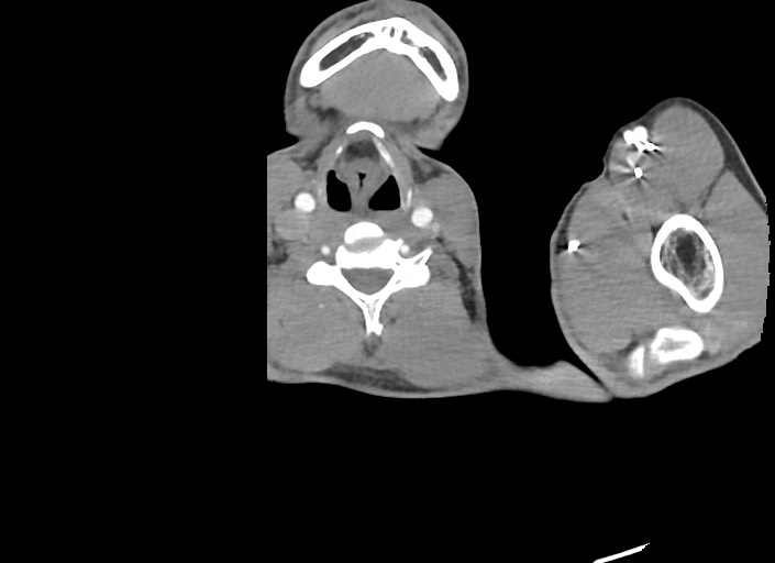 File:Aortic coarctation with aneurysm (Radiopaedia 74818-85828 A 207).jpg