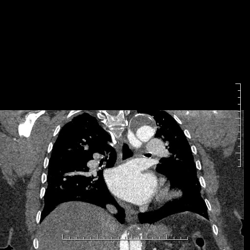 Aortic dissection- Stanford A (Radiopaedia 35729-37268 E 18).jpg
