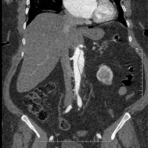 Aortic dissection- Stanford A (Radiopaedia 35729-37268 F 33).jpg