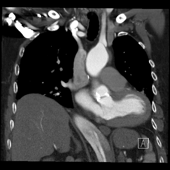 Aortic dissection (CTPA) (Radiopaedia 75506-86750 B 31).jpg