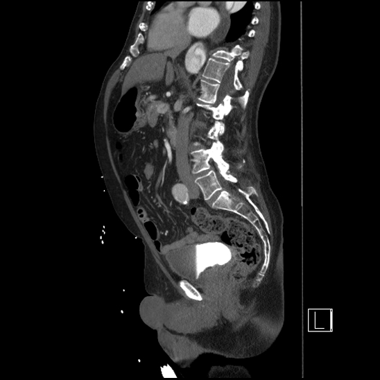 Aortic dissection (CTPA) (Radiopaedia 75506-86750 G 53).jpg
