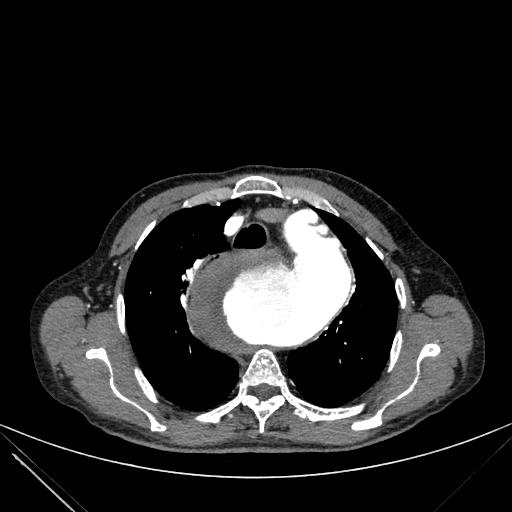 Aortic dissection (Radiopaedia 27466-27665 C+ arterial phase 45).jpg
