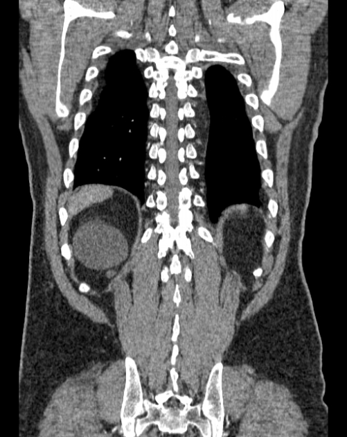 Aortic dissection (Radiopaedia 44411-48061 A 60).jpg