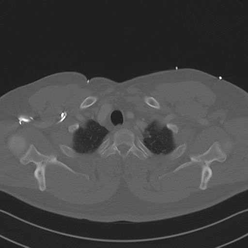 Aortic dissection (Radiopaedia 50763-56234 Axial bone window 17).png