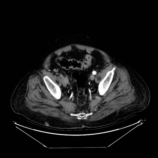 Aortic dissection (Radiopaedia 62562-71000 A 99).jpg
