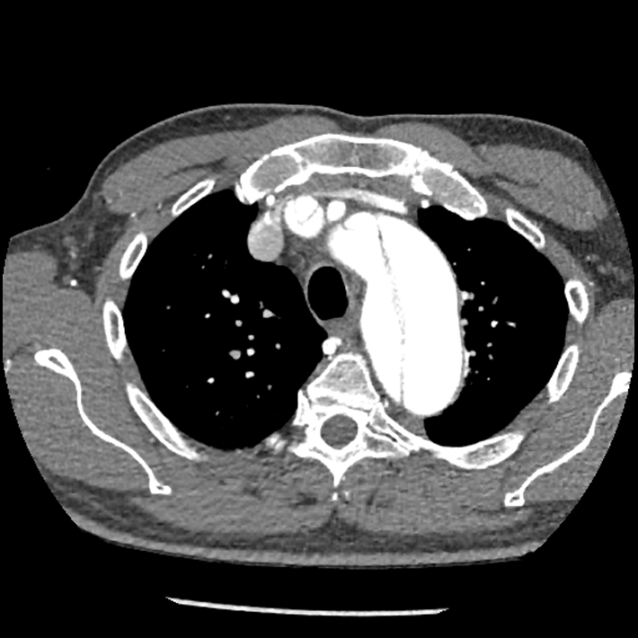Aortic dissection - DeBakey Type I-Stanford A (Radiopaedia 79863-93115 A 8).jpg