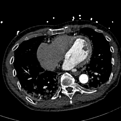 File:Aortic dissection - DeBakey type II (Radiopaedia 64302-73082 A 61).png