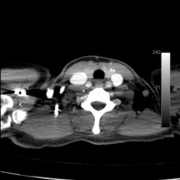 Aortic dissection - Stanford type A (Radiopaedia 29247-29659 A 2).jpg
