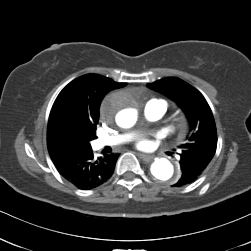 File:Aortic dissection - Stanford type A (Radiopaedia 39073-41259 A 39).png