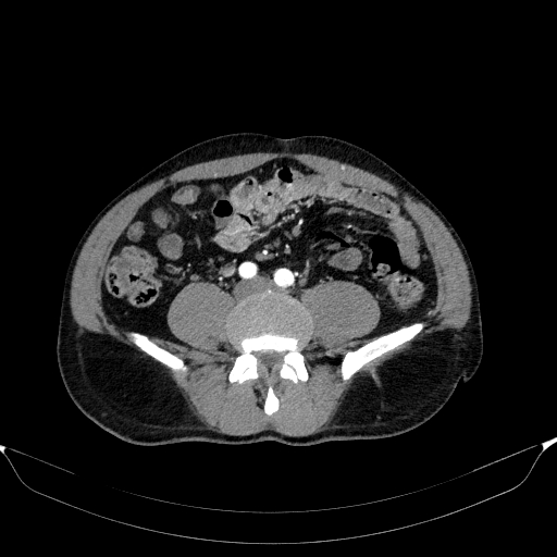 Aortic dissection - Stanford type A (Radiopaedia 83418-98500 A 92).jpg