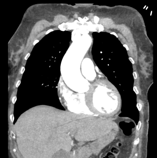 Aortic dissection - Stanford type B (Radiopaedia 50171-55512 B 28).png