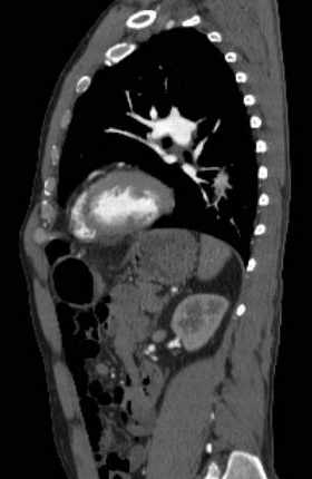 File:Aortic dissection - Stanford type B (Radiopaedia 73648-84437 C 51).jpg