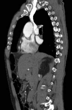 File:Aortic dissection - Stanford type B (Radiopaedia 73648-84437 C 91).jpg