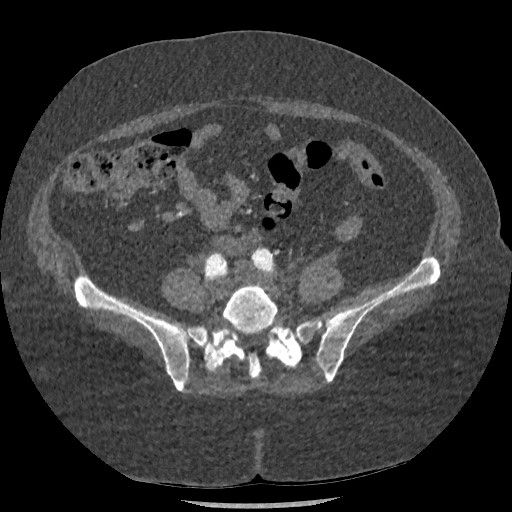 File:Aortic dissection - Stanford type B (Radiopaedia 88281-104910 A 136).jpg
