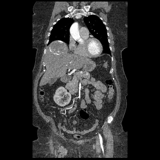 File:Aortic dissection - Stanford type B (Radiopaedia 88281-104910 B 17).jpg