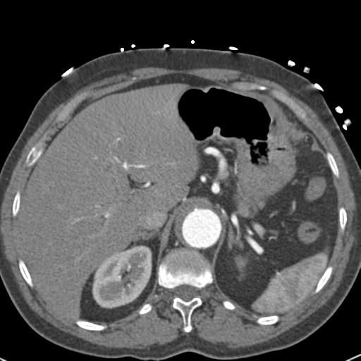 Aortic intramural hematoma (Radiopaedia 31139-31838 B 83).jpg