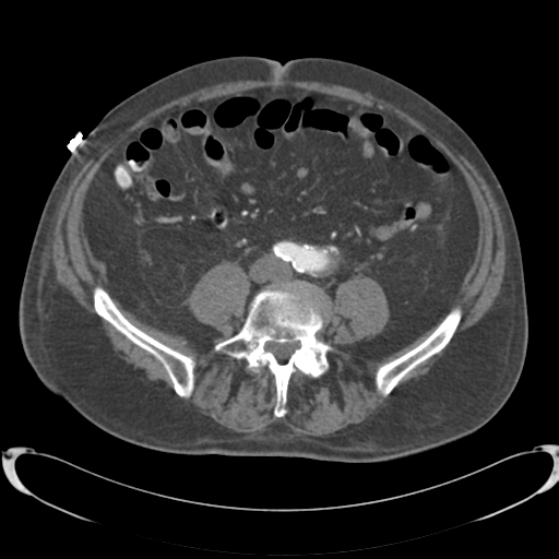 Aortic intramural hematoma (Radiopaedia 34260-35540 B 68).png