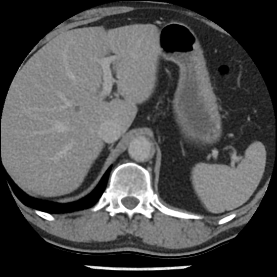 Aortic intramural hematoma (type B) (Radiopaedia 79323-92387 Axial C+ delayed 54).jpg