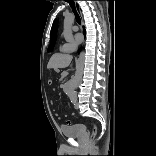 Aortic intramural hematoma (type B) (Radiopaedia 79323-92387 G 25).jpg