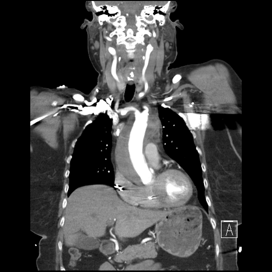 Aortic intramural hematoma with dissection and intramural blood pool (Radiopaedia 77373-89491 C 21).jpg