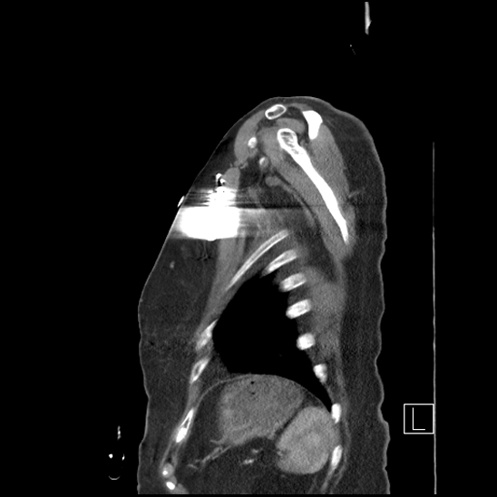 File:Aortic intramural hematoma with dissection and intramural blood pool (Radiopaedia 77373-89491 D 80).jpg
