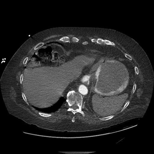Aortoesophageal fistula with endovascular repair (Radiopaedia 73781-84592 Axial C+ CTPA 145).jpg