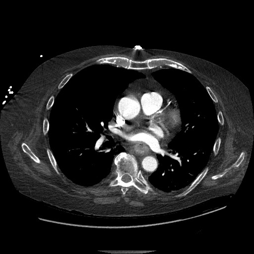 Aortoesophageal fistula with endovascular repair (Radiopaedia 73781-84592 Axial C+ CTPA 81).jpg