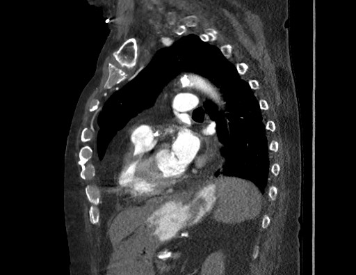 Aortoesophageal fistula with endovascular repair (Radiopaedia 73781-84592 Sagittal C+ CTPA 125).jpg