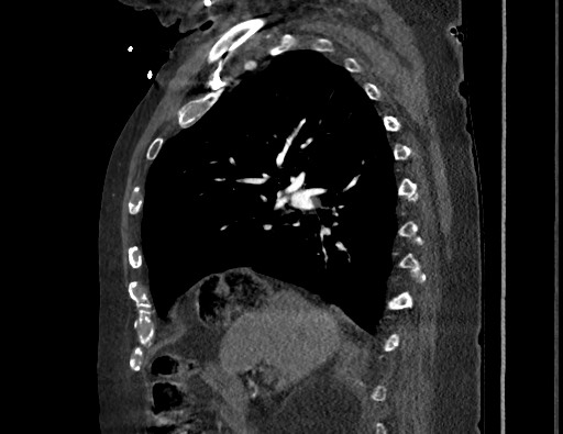 Aortoesophageal fistula with endovascular repair (Radiopaedia 73781-84592 Sagittal C+ CTPA 69).jpg