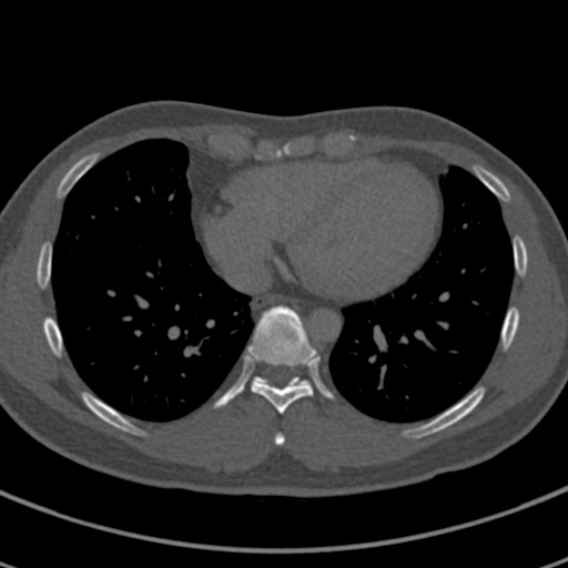 File:Apical lung mass mimic - neurogenic tumor (Radiopaedia 59918-67521 Axial bone window 56).jpg