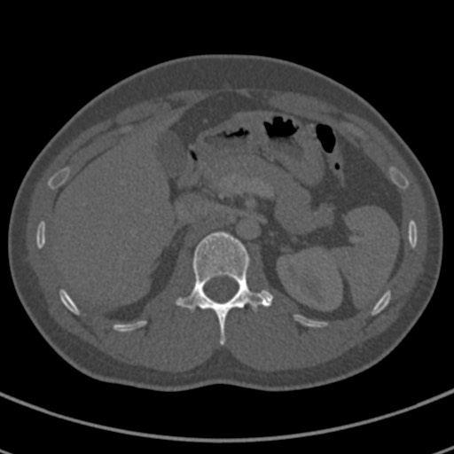Apical lung mass mimic - neurogenic tumor (Radiopaedia 59918-67521 Axial bone window 88).jpg