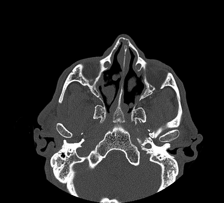 Aplastic maxillary sinuses (Radiopaedia 60030-67561 Axial non-contrast 34).jpg
