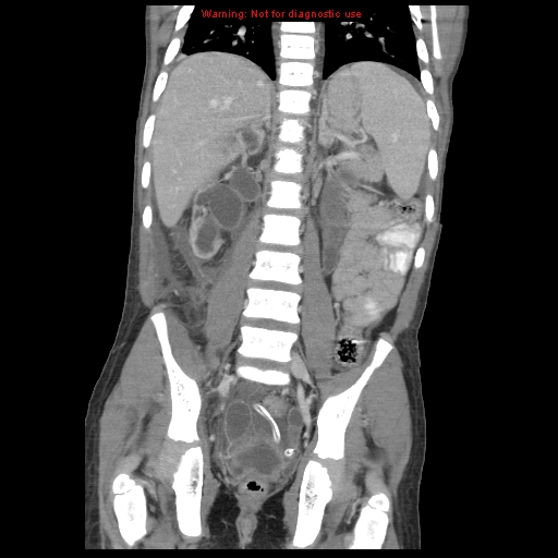 File:Appendicitis with phlegmon (Radiopaedia 9358-10046 B 45).jpg