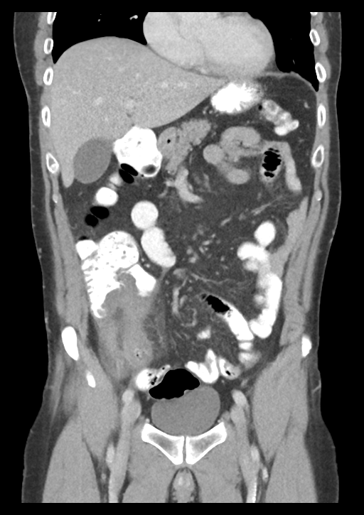 Appendicitis with thickening of the terminal ileum (Radiopaedia 42432-45550 B 21).png