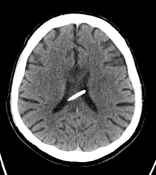 File:Aqueduct stenosis with corpus callosum hypoattenuation post shunting (Radiopaedia 37212-38971 Axial non-contrast 18).png