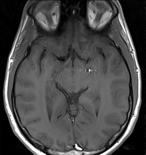 File:Arachnoid cyst - cerebellopontine angle (Radiopaedia 59689-67083 Axial T1 21).png
