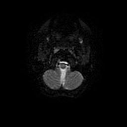 Arachnoid cyst - middle cranial fossa (Radiopaedia 67671-77088 Axial DWI 29).jpg